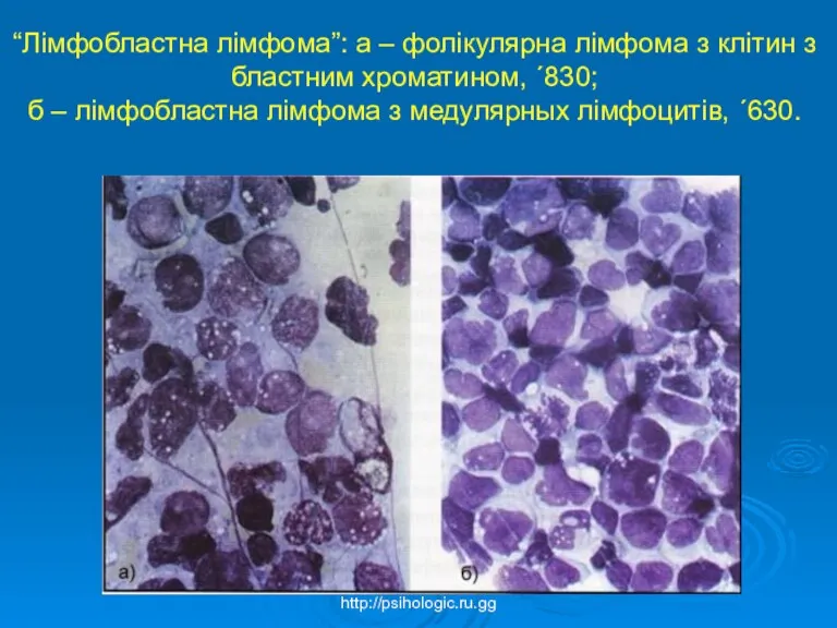 “Лімфобластна лімфома”: а – фолікулярна лімфома з клітин з бластним