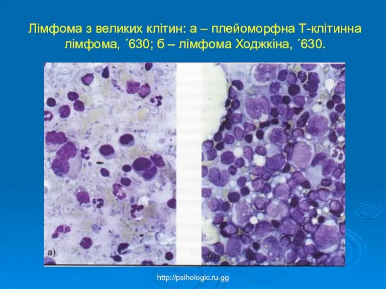 Лімфома з великих клітин: а – плейоморфна Т-клітинна лімфома, ´630; б – лімфома Ходжкіна, ´630. http://psihologic.ru.gg