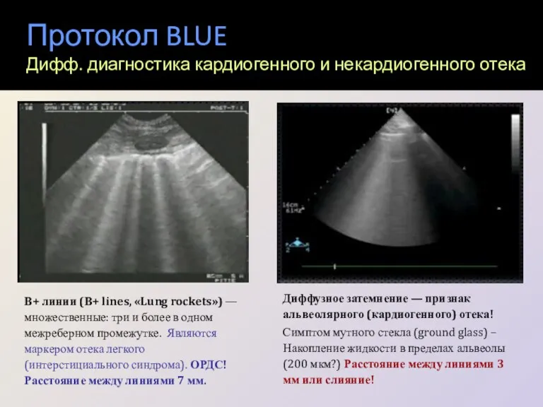 Протокол BLUE Дифф. диагностика кардиогенного и некардиогенного отека В+ линии (В+ lines, «Lung