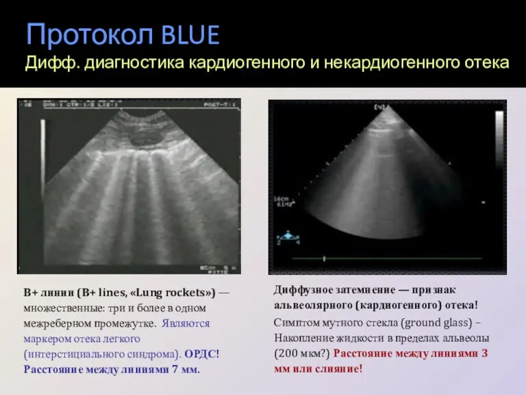 Протокол BLUE Дифф. диагностика кардиогенного и некардиогенного отека В+ линии