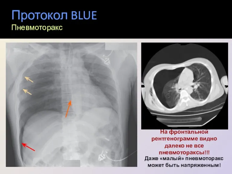 Протокол BLUE Пневмоторакс На фронтальной рентгенограмме видно далеко не все пневмотораксы!!! Даже «малый»