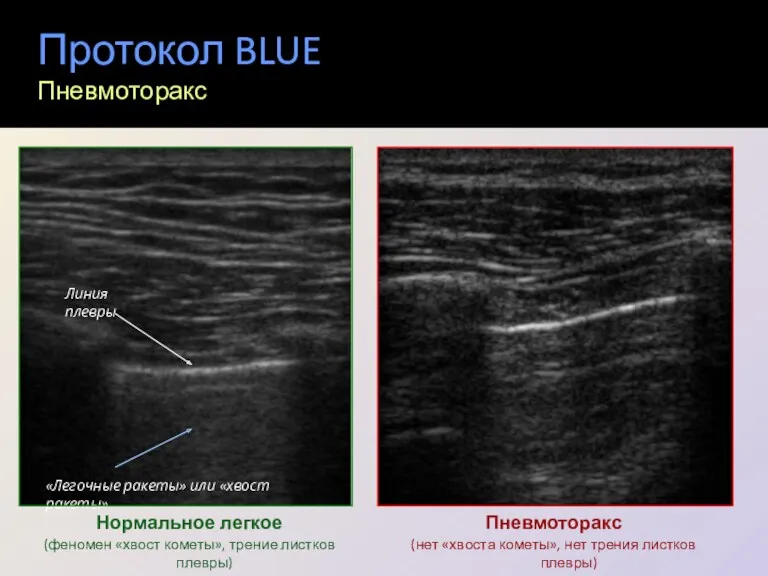 Протокол BLUE Пневмоторакс Нормальное легкое (феномен «хвост кометы», трение листков