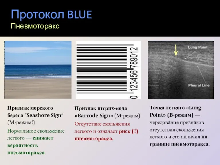Протокол BLUE Пневмоторакс Признак штрих-кода «Barcode Sign» (М-режим) Отсутствие скольжения легкого и означает