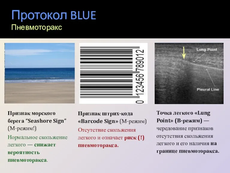 Протокол BLUE Пневмоторакс Признак штрих-кода «Barcode Sign» (М-режим) Отсутствие скольжения