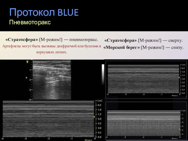 Протокол BLUE Пневмоторакс «Стратосфера» (М-режим!) — пневмоторакс. Артефакты могут быть вызваны диафрагмой или