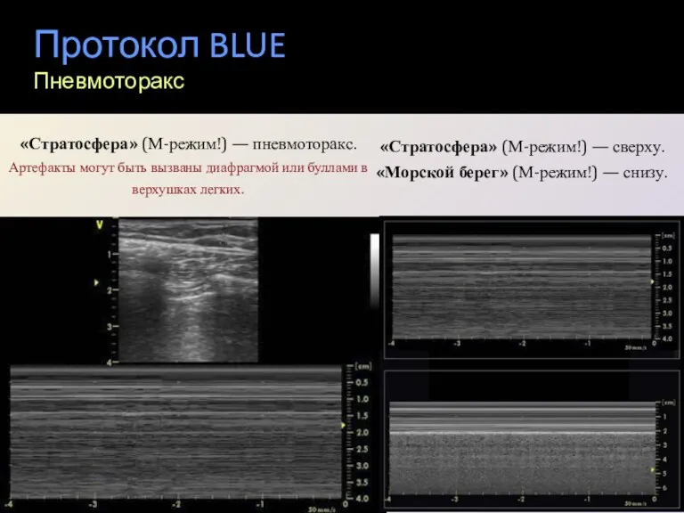 Протокол BLUE Пневмоторакс «Стратосфера» (М-режим!) — пневмоторакс. Артефакты могут быть