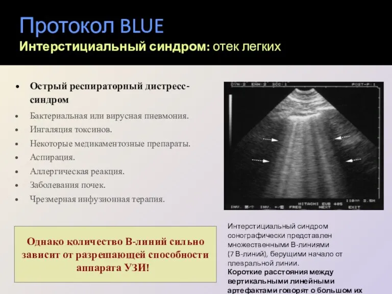 Протокол BLUE Интерстициальный синдром: отек легких Острый респираторный дистресс-синдром Бактериальная или вирусная пневмония.