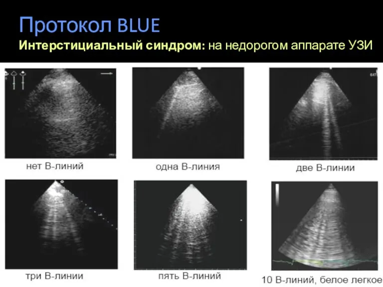 Протокол BLUE Интерстициальный синдром: на недорогом аппарате УЗИ