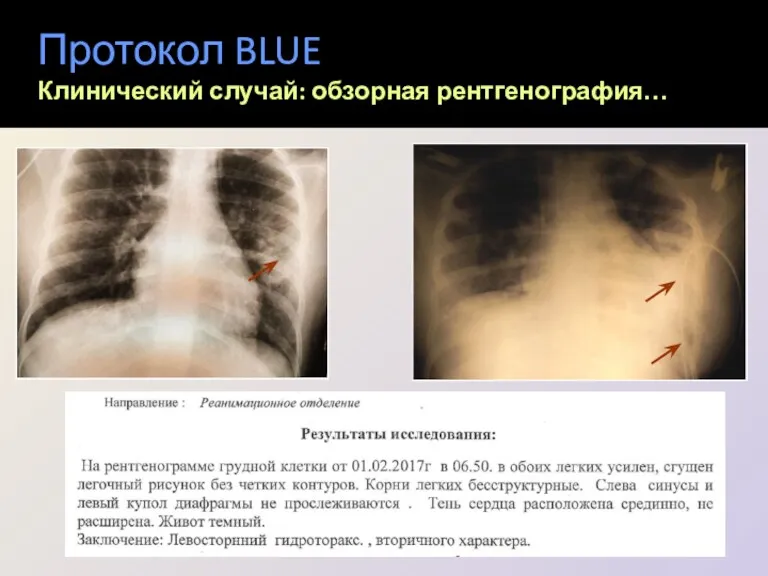 Протокол BLUE Клинический случай: обзорная рентгенография…