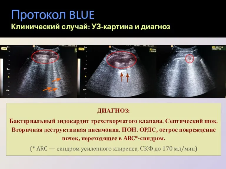 Протокол BLUE Клинический случай: УЗ-картина и диагноз Признаки ОРДС, множественные двухсторонние консолидации! Усиление