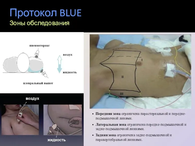 Протокол BLUE Зоны обследования Передняя зона ограничена парастернальной и передне-подмышечной