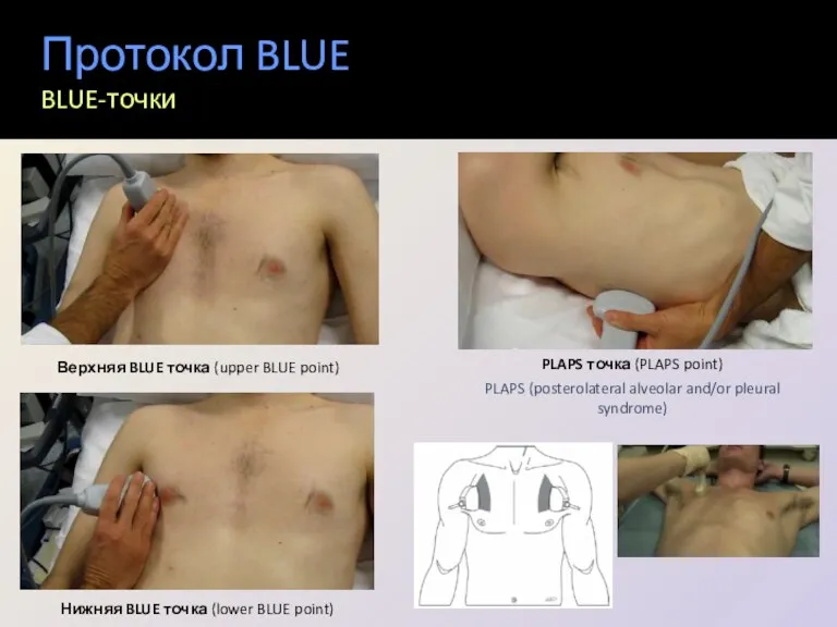 Протокол BLUE BLUE-точки PLAPS точка (PLAPS point) PLAPS (posterolateral alveolar and/or pleural syndrome)