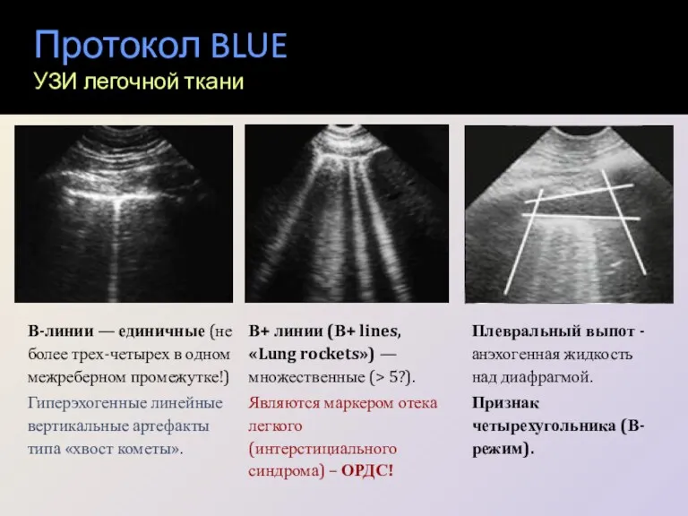 Протокол BLUE УЗИ легочной ткани В-линии ― единичные (не более трех-четырех в одном