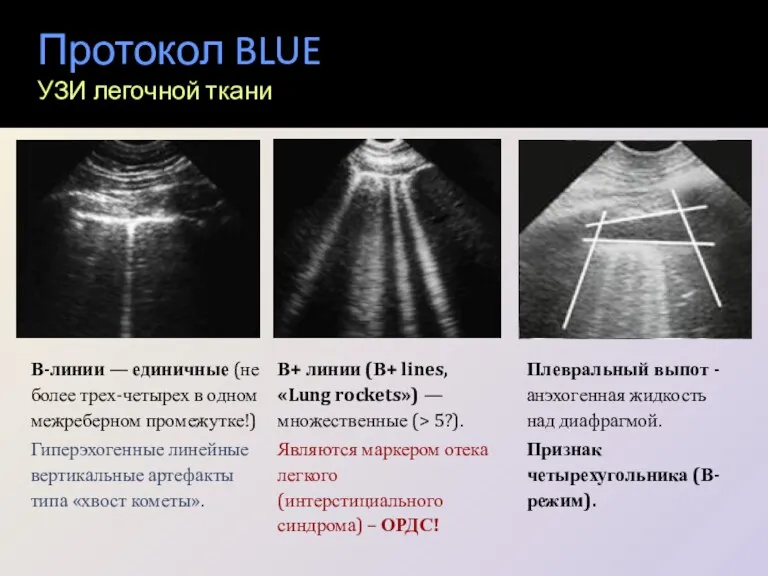 Протокол BLUE УЗИ легочной ткани В-линии ― единичные (не более