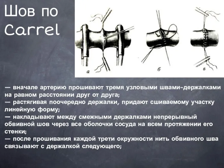 Шов по Carrel — вначале артерию прошивают тремя узловыми швами-держалками