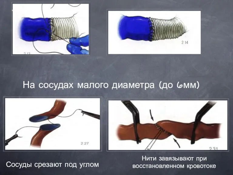 4 - Завершение На сосудах малого диаметра (до 6мм) Сосуды