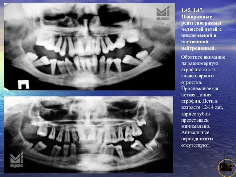АНИСИМОВА Л.В.кмн. 1.45, 1.47. Панорамные рентгенограммы челюстей детей с циклической и постоянной нейтропенией.