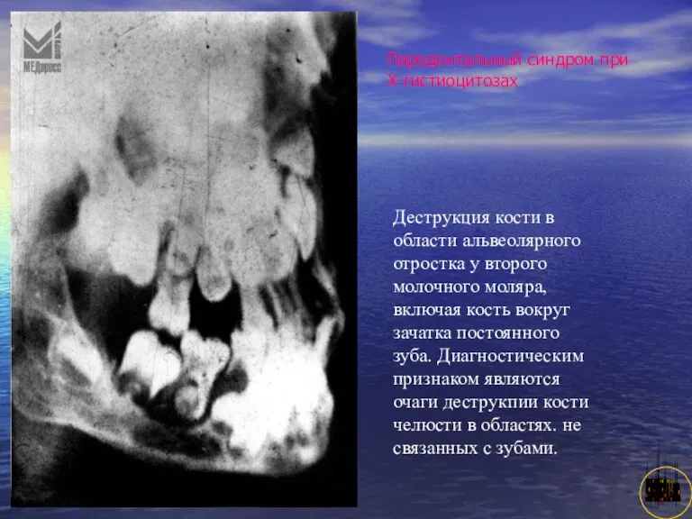 АНИСИМОВА Л.В.кмн. Деструкция кости в области альвеолярного отростка у второго молочного моляра, включая