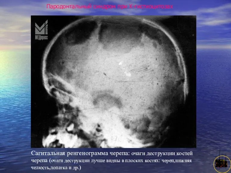 АНИСИМОВА Л.В.кмн. Пародонтальный синдром при Х-гистиоцитозах Сагитальная ренгенограмма черепа: очаги деструкции костей черепа