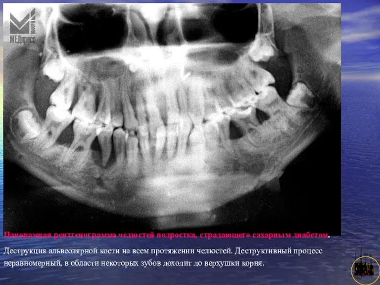 АНИСИМОВА Л.В.кмн. Панорамная рентгенограмма челюстей подростка, страдающего сахарным диабетом. Деструкция альвеолярной кости на