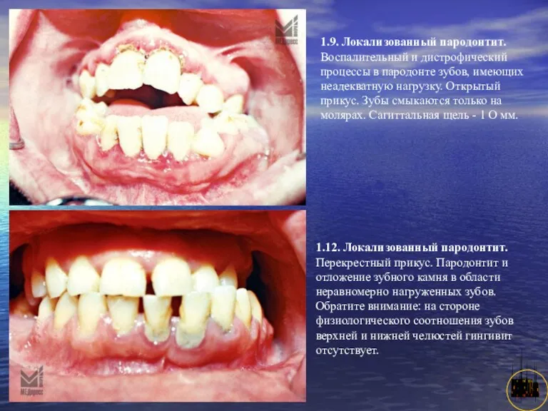 АНИСИМОВА Л.В.кмн. 1.9. Локализованный пародонтит. Воспалительный и дистрофический процессы в пародонте зубов, имеющих