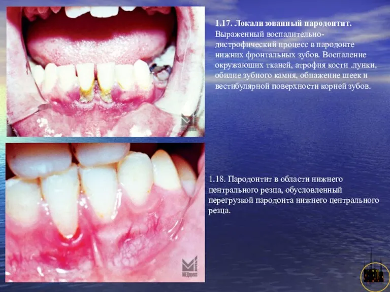 АНИСИМОВА Л.В.кмн. 1.17. Локализованный пародонтит. Выраженный воспалительно-дистрофический процесс в пародонте нижних фронтальных зубов.