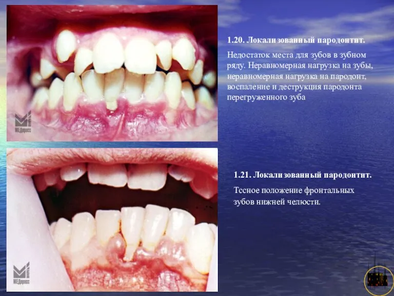 АНИСИМОВА Л.В.кмн. 1.20. Локализованный пародонтит. Недостаток места для зубов в зубном ряду. Неравномерная