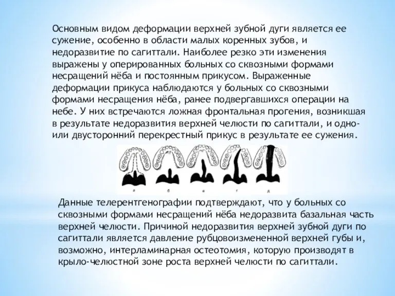 Основным видом деформации верхней зубной дуги является ее сужение, особенно