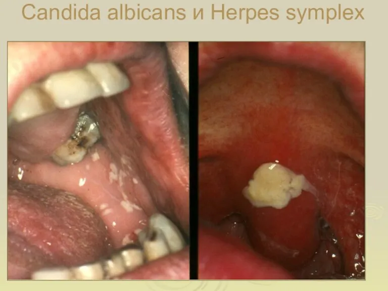 Candida albicans и Herpes symplex