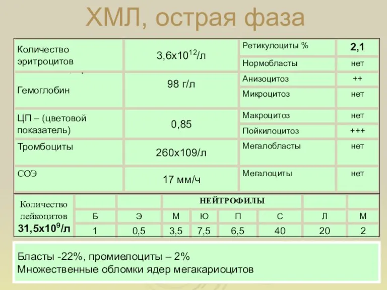 ХМЛ, острая фаза Бласты -22%, промиелоциты – 2% Множественные обломки ядер мегакариоцитов