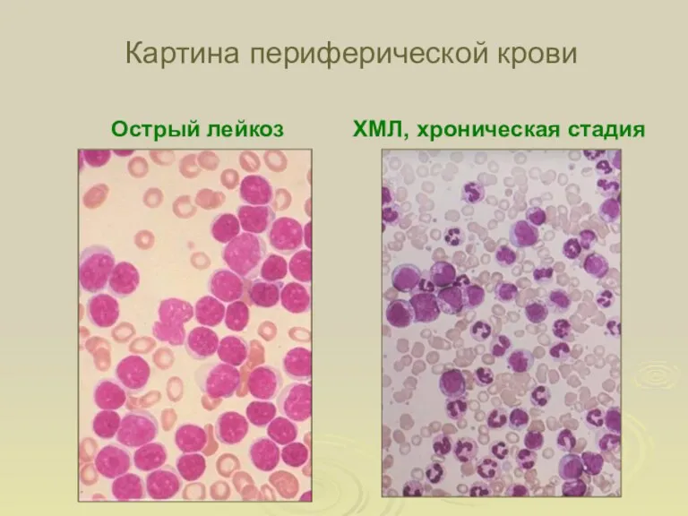 Картина периферической крови Острый лейкоз ХМЛ, хроническая стадия