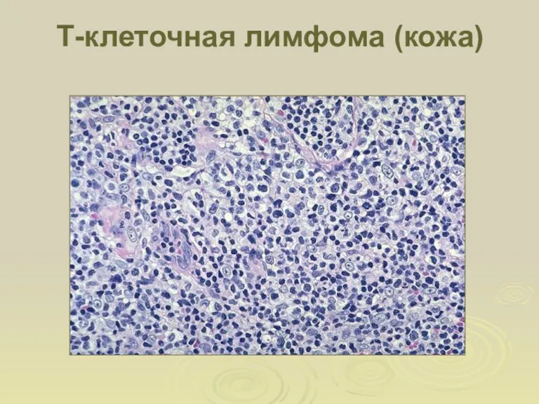 Т-клеточная лимфома (кожа)