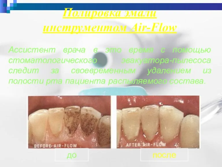 Полировка эмали инструментом Air-Flow Ассистент врача в это время с