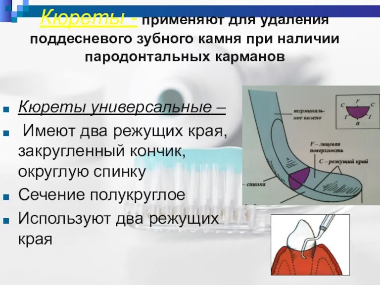 Кюреты - применяют для удаления поддесневого зубного камня при наличии