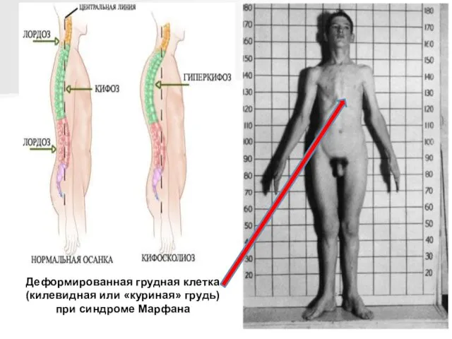 Деформированная грудная клетка (килевидная или «куриная» грудь) при синдроме Марфана