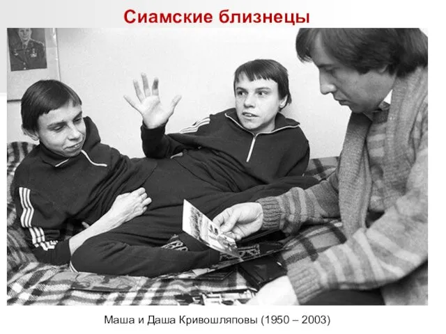 Сиамские близнецы Маша и Даша Кривошляповы (1950 – 2003)