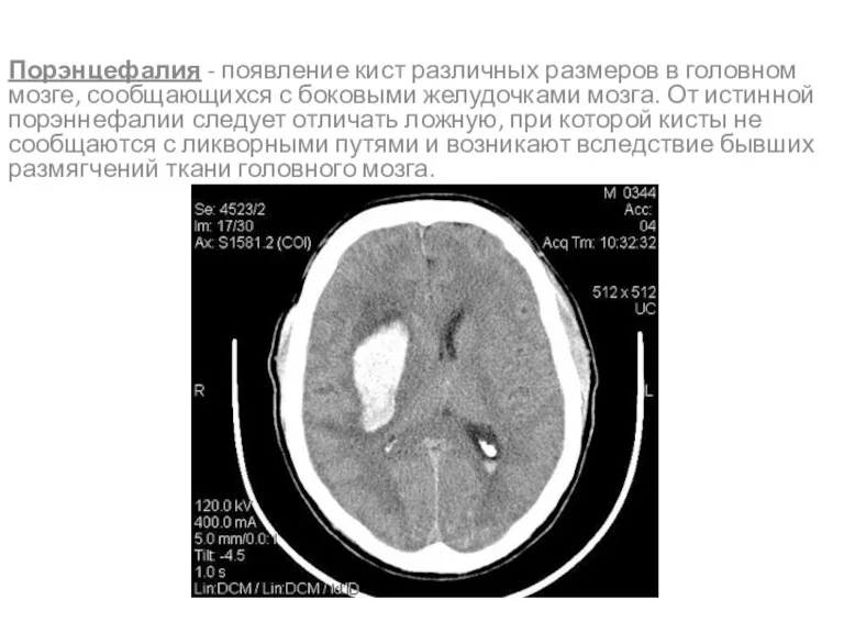 Порэнцефалия - появление кист различных размеров в головном мозге, сообщающихся