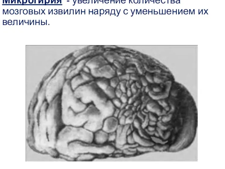 Микрогирия - увеличение количества мозговых извилин наряду с уменьшением их величины.