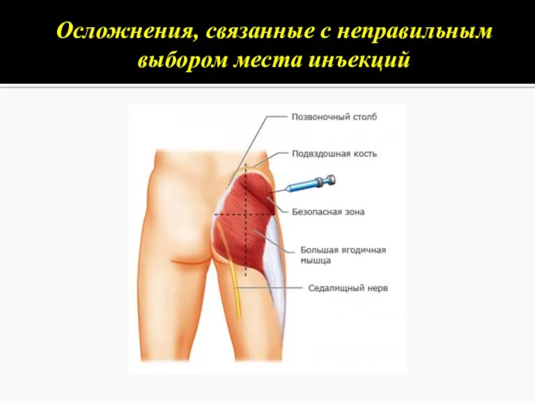 Осложнения, связанные с неправильным выбором места инъекций