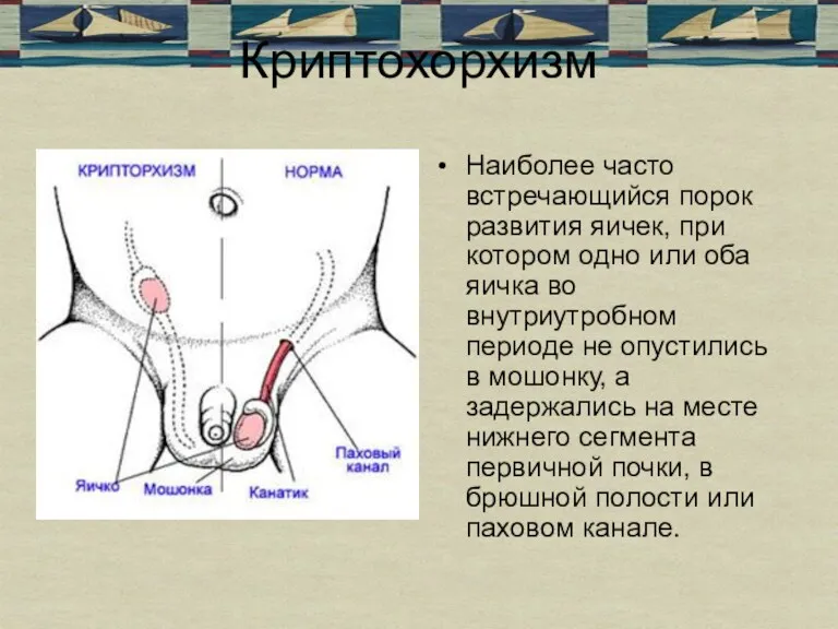 Криптохорхизм Наиболее часто встречающийся порок развития яичек, при котором одно