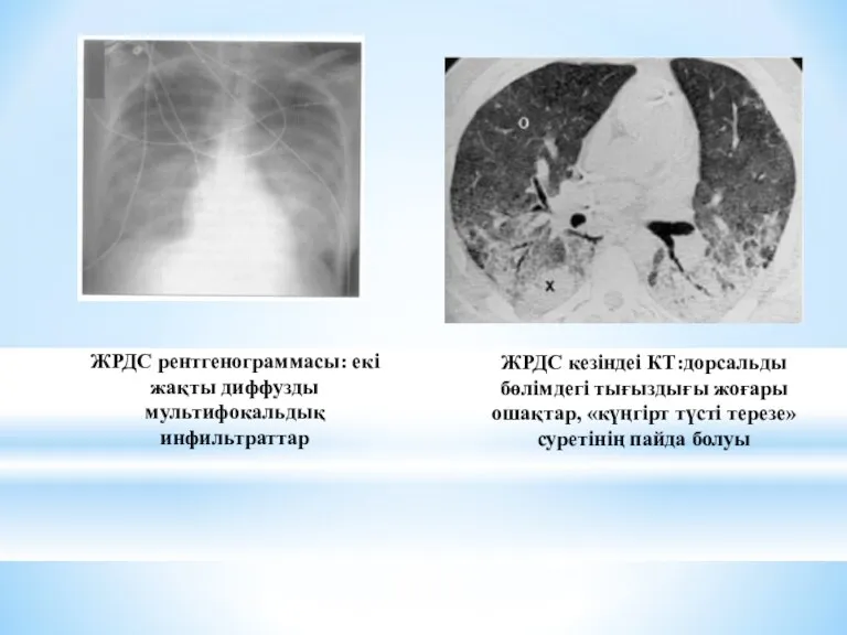 Рентгенологическая картина при ОРДС: двусторонние диффузные мультифокальные инфильтраты. Рис. 3. КТ при ОРДС: