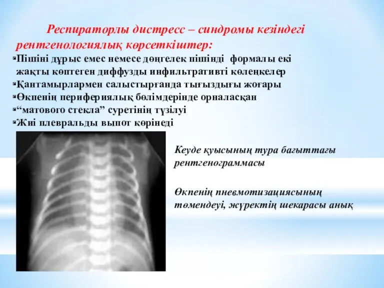 Респираторлы дистресс – синдромы кезіндегі рентгенологиялық көрсеткіштер: Пішіні дұрыс емес