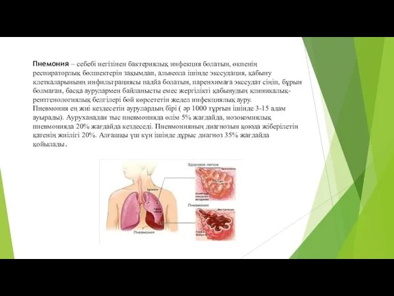 Пнемония – себебі негізінен бактериялық инфекция болатын, өкпенің респираторлық бөлшектерін