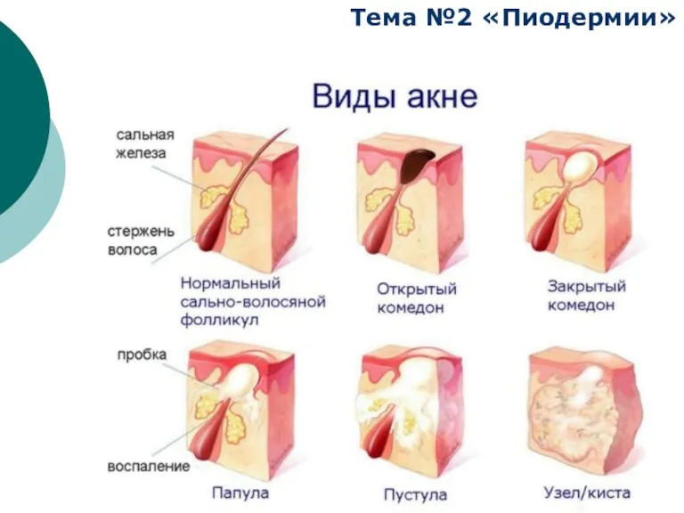 Тема №2 «Пиодермии»