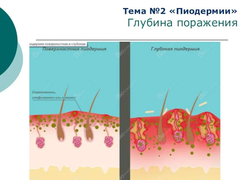 Тема №2 «Пиодермии» Глубина поражения