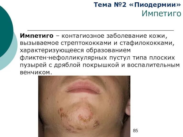 Тема №2 «Пиодермии» Импетиго Импетиго – контагиозное заболевание кожи, вызываемое