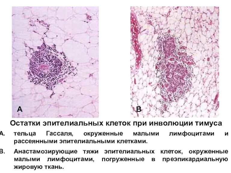 Анастамозирующие тяжи эпителиальных клеток, окруженные малыми лимфоцитами, погруженные в преэпикардиальную