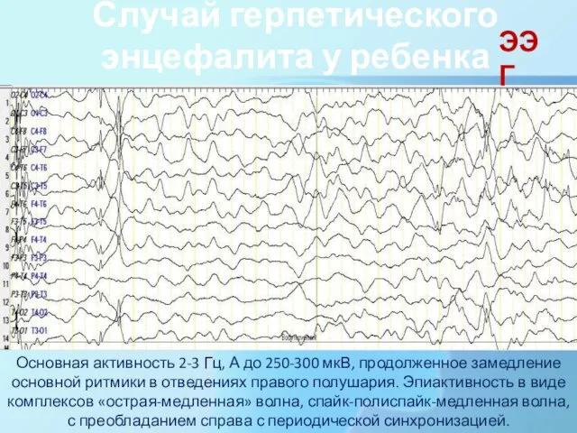 Случай герпетического энцефалита у ребенка Основная активность 2-3 Гц, А до 250-300 мкВ,