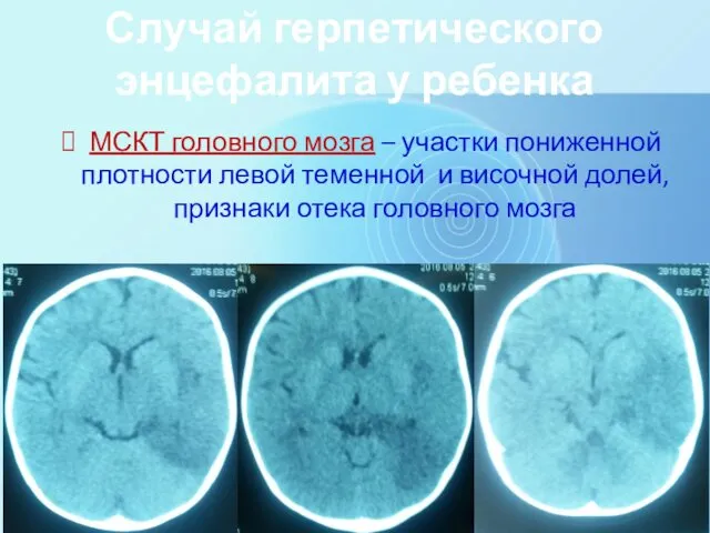 МСКТ головного мозга – участки пониженной плотности левой теменной и височной долей, признаки