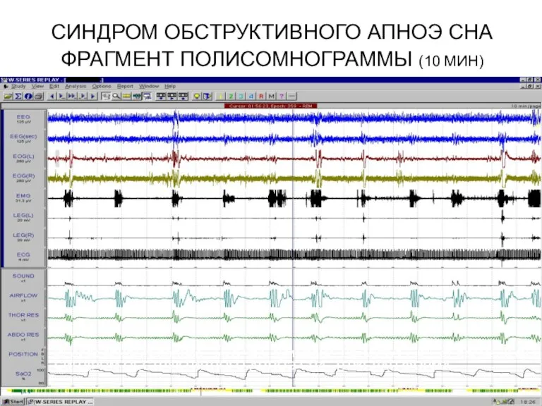 СИНДРОМ ОБСТРУКТИВНОГО АПНОЭ СНА ФРАГМЕНТ ПОЛИСОМНОГРАММЫ (10 МИН) Индекс апноэ/гипопноэ